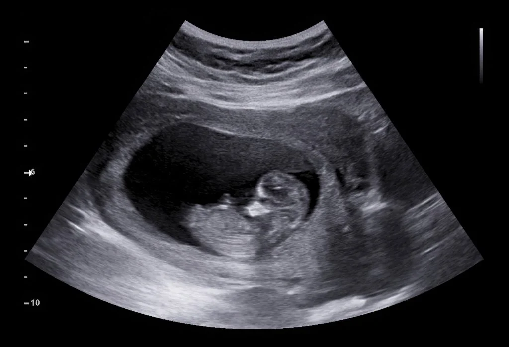 Ultrasound Analysis